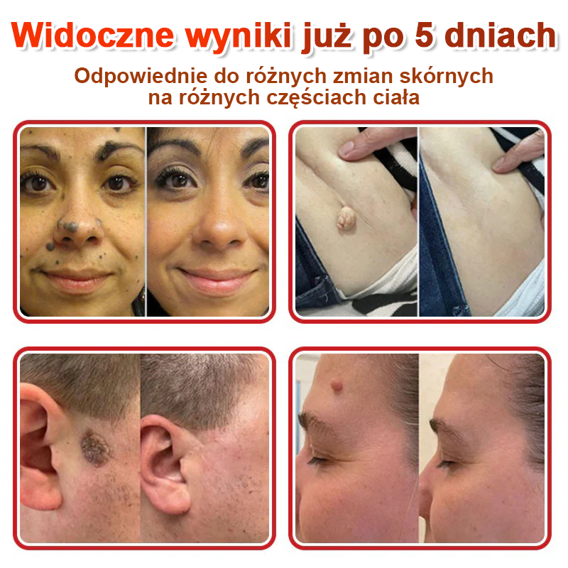 🌈 KUBOZN® mikrotűs botanikai tapasz a bőr szemölcseinek eltávolítására