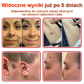 🌈 KUBOZN® mikrotűs botanikai tapasz a bőr szemölcseinek eltávolítására