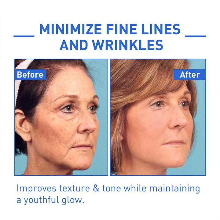 BOTOX ARCSZÉRUM | VEGYÉL 1-ET ÉS KAPSZ 1-ET INGYEN